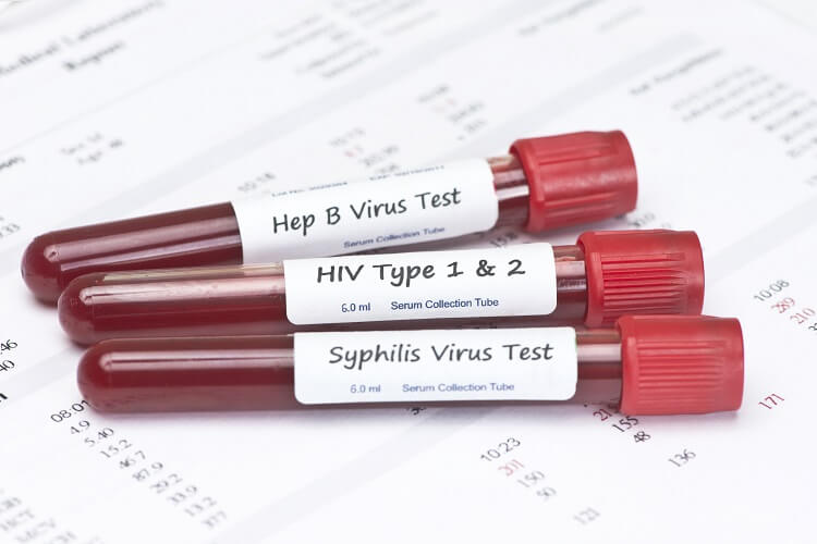 Three blood vials at a lab marked for testing of different sexually transmitted infections